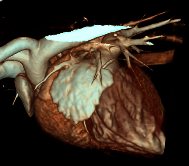 3kg cardiac CT 3D recon