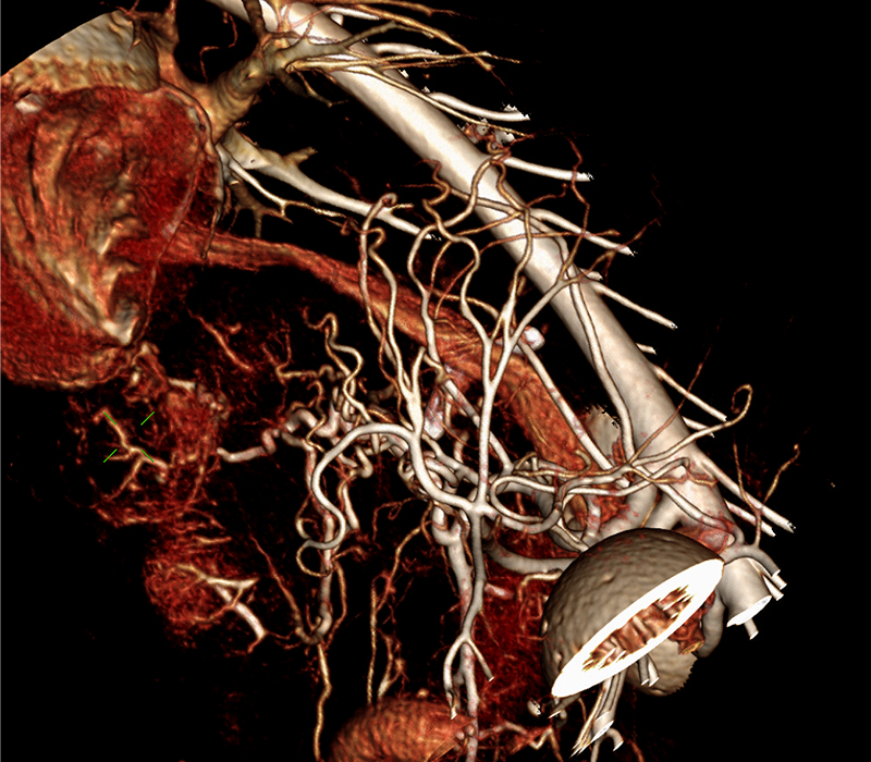 4kg abdominal aorta 3D recon